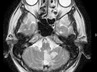 磁気を用いて、脳の内部の様子を輪切りの鮮明な画像として見ることができる検査法のことです。脳の内部に腫瘍などは発生していないか、脳梗塞はできていないかといったことがわかります。X線を使わないので被曝の心配もありません。 title=頭部MRI